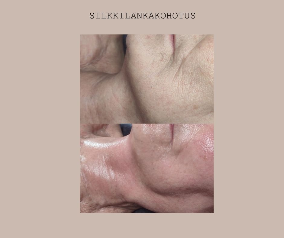Silkkilankakohotus(6)