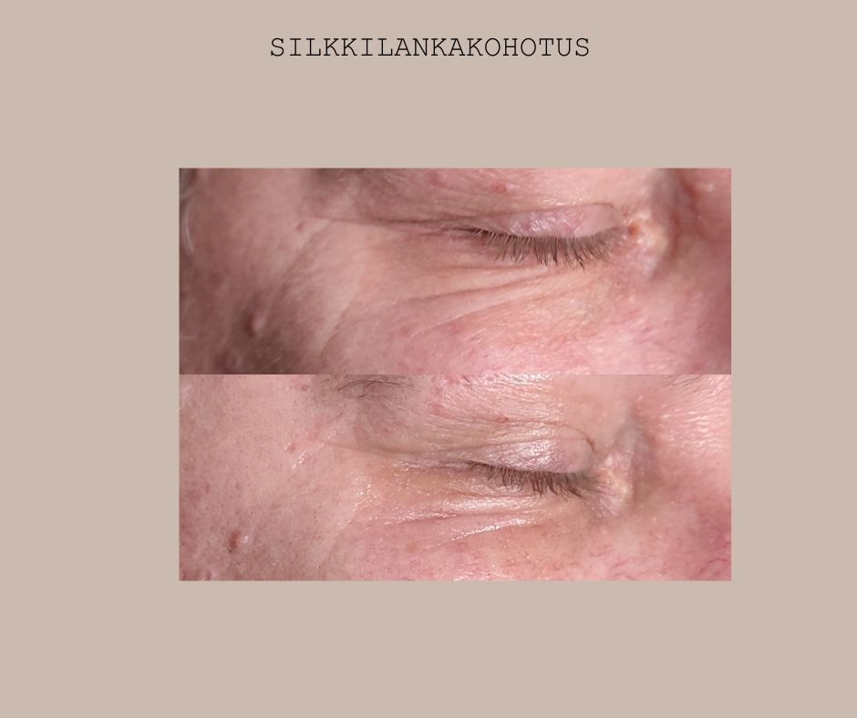 Silkkilankakohotus(9)